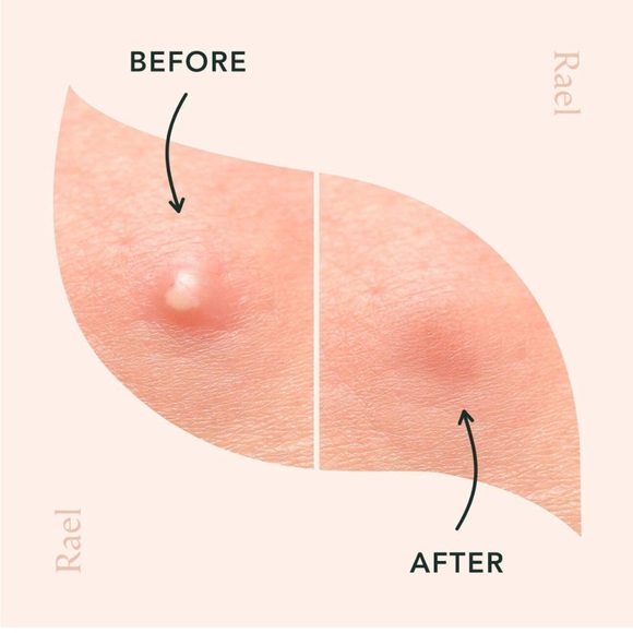 NWT Rael Beauty Miracle Patch Hydrocolloid, Acne Pimple Absorbing Cover, Blemish - Picture 4 of 6